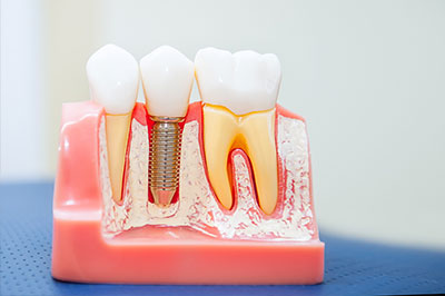 McGregor Dental at McGregor Point | Crowns  amp  Caps, Root Canals and Implant Restoration