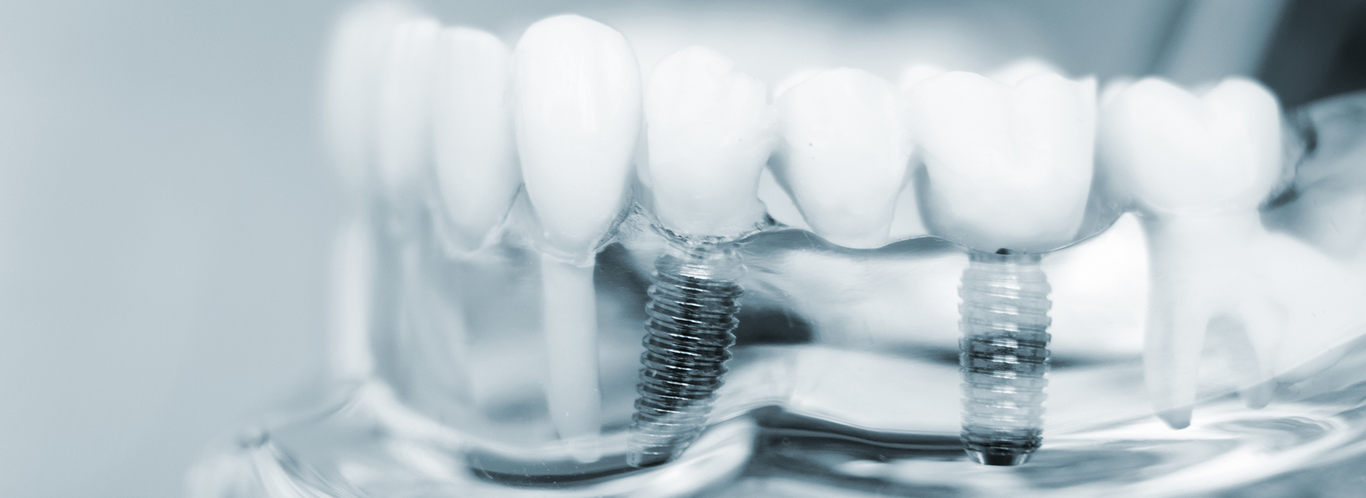 McGregor Dental at McGregor Point | Veneers, Preventative Program and Implant Restoration