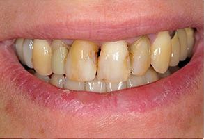 McGregor Dental at McGregor Point | Root Canals, Veneers and Dentures