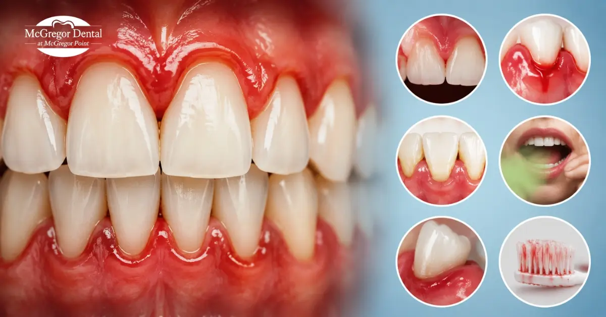 Gum Disease Symptoms - Early Signs to Watch For In 2026 Fort Myers